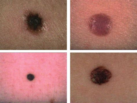 small nodular melanoma pictures